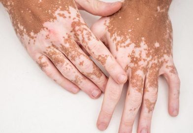 Científicos del IPN Investigan Vínculo de la Obesidad como Factor de Vitíligo